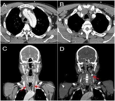 Case report: Multi-site perfusion strategy for type A acute aortic dissection complicated with cerebral malperfusion